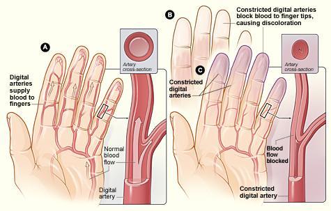 Raynaud's image of hands